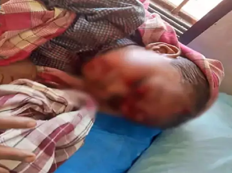 CG : 4 साल के मासूम पर आवारा कुत्ते का हमला, सिर-मुंह समेत 17 जगह गंभीर जख्म …